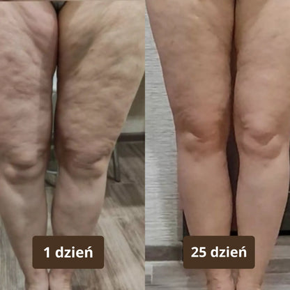 SmoothCup - antycellulitowy masażer próżniowy